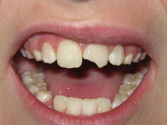 Dental Bonding #9