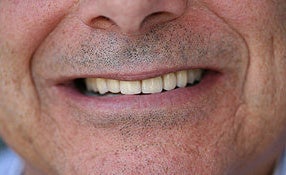 Full Porcelain Crowns (no metal)