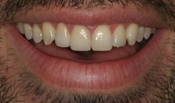 Ceramic crowns after trauma