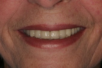 Full-mouth Reconstruction