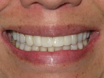Porcelain Crowns 