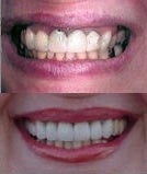 Porcelain crowns