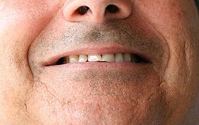 Full Porcelain Crowns (no metal)