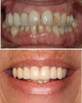Full porcelain crowns
