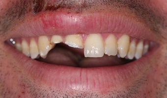 Ceramic crowns after trauma