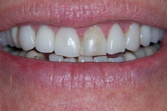 e-max crowns