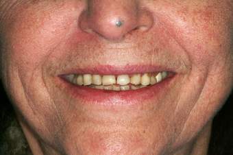 Full-mouth Reconstruction