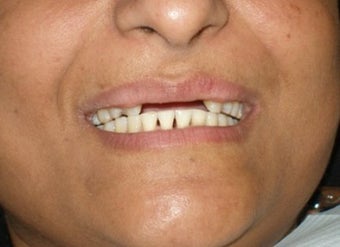 Cosmetic Dentistry Fixed Prosthesis