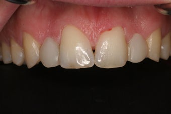 Dental Crowns 