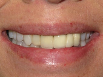 Porcelain Crowns 
