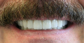 Full mouth rehabilitation using  20 implants to restore 28 teeth