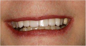Dental Implant
