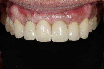 Dental implants in the smile zone