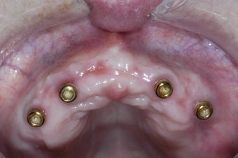 Dental implants supporting a full upper denture