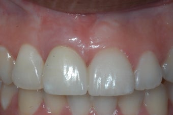 Replacment of missing tooth with dental implant