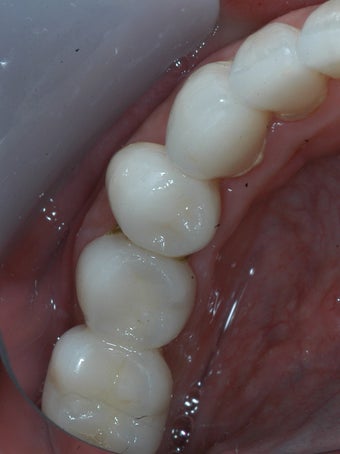 Missing lower teeth replaced with bone grafting and implants