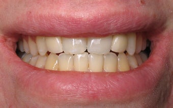 Dental Implants to Replace Missing Teeth