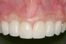 Congenital missing teeth and implants