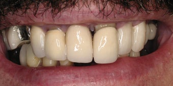 Full mouth rehabilitation using  20 implants to restore 28 teeth