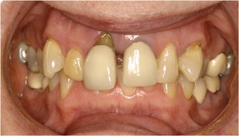 Dental Implant