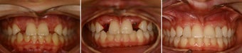 Dental implants before and after