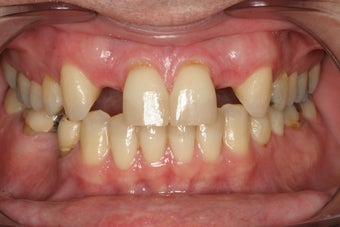Implants Replacing Two Front Teeth