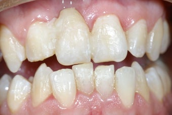 Dental implant to replace missing upper front incisor