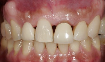 Dental implants in the smile zone