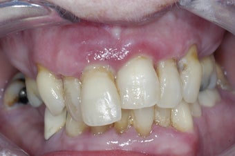Dental implants supporting a full upper denture