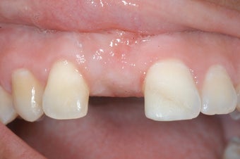 Replacment of missing tooth with dental implant