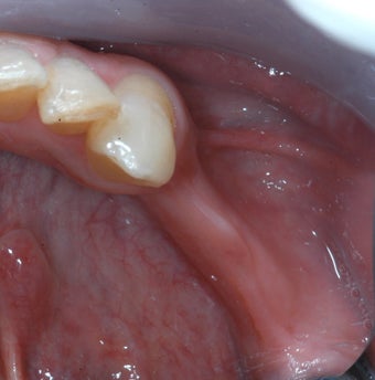 Missing lower teeth replaced with bone grafting and implants