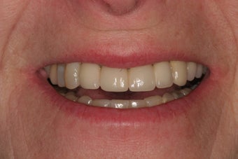 Implant Bridge