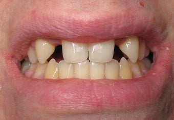 Dental Implants to Replace Missing Teeth