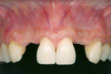 Congenital missing teeth and implants