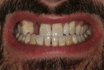 Smile Makeover: Veneers and a Bridge