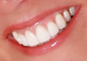 Gum Lift and Porcelain Veneers