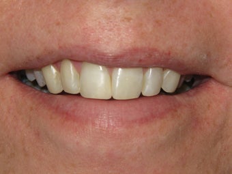 Internal Bleaching and Bonding