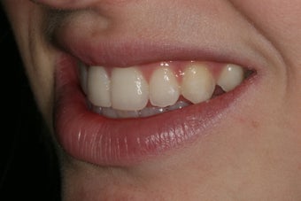 Cosmetic Bonding