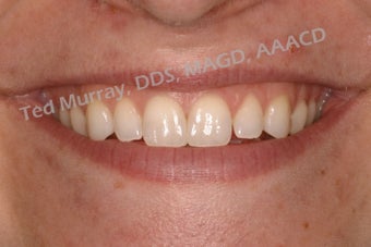 Cosmetic Bonding to close space