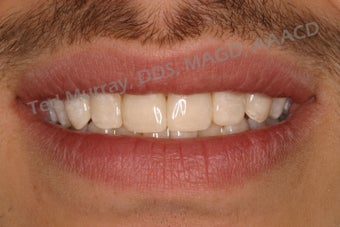 Direct Composite Resin Veneers