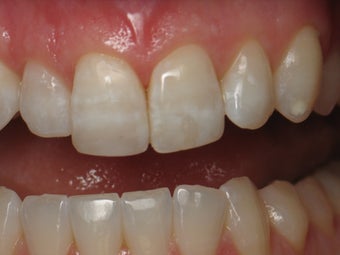 Dental Bonding
