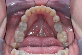 Mercury Silver filling replacment