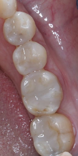 Mercury Silver filling replacement