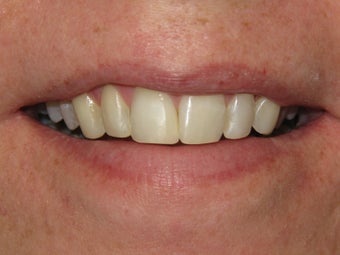 Teeth Bonding