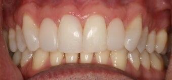 Cosmetic bonding and gum lift