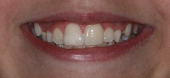 Cosmetic Composite Resin for Broken Front Tooth in Teenager