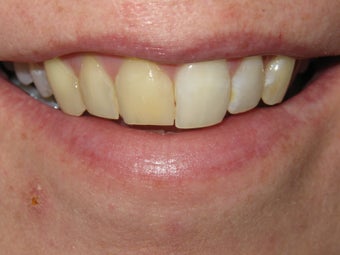 Internal Bleaching and Bonding
