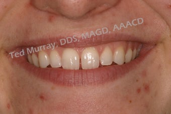Cosmetic Bonding to close space
