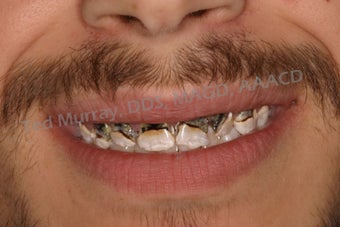 Direct Composite Resin Veneers