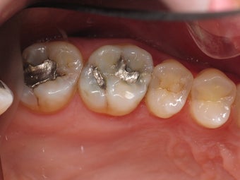 Mercury Silver filling replacment